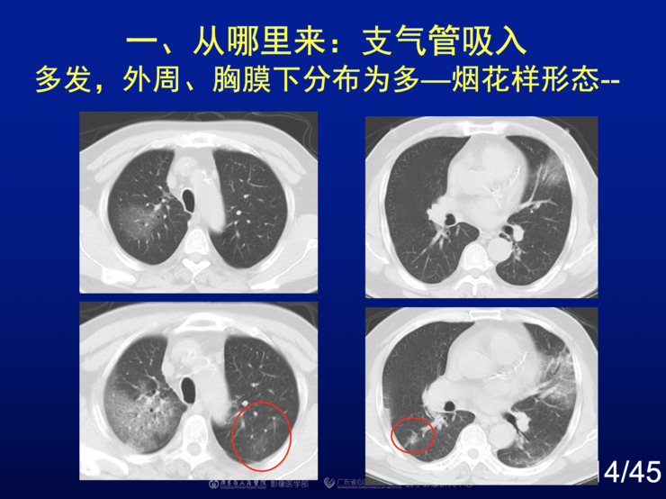 新疆新冠肺炎最早信息