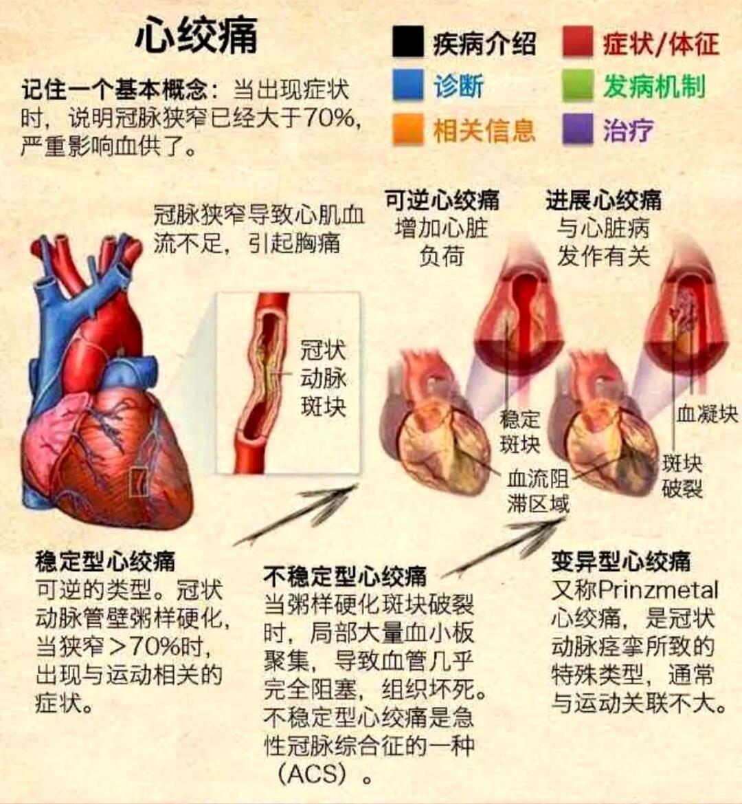 心绞痛最早分型及其临床意义探究